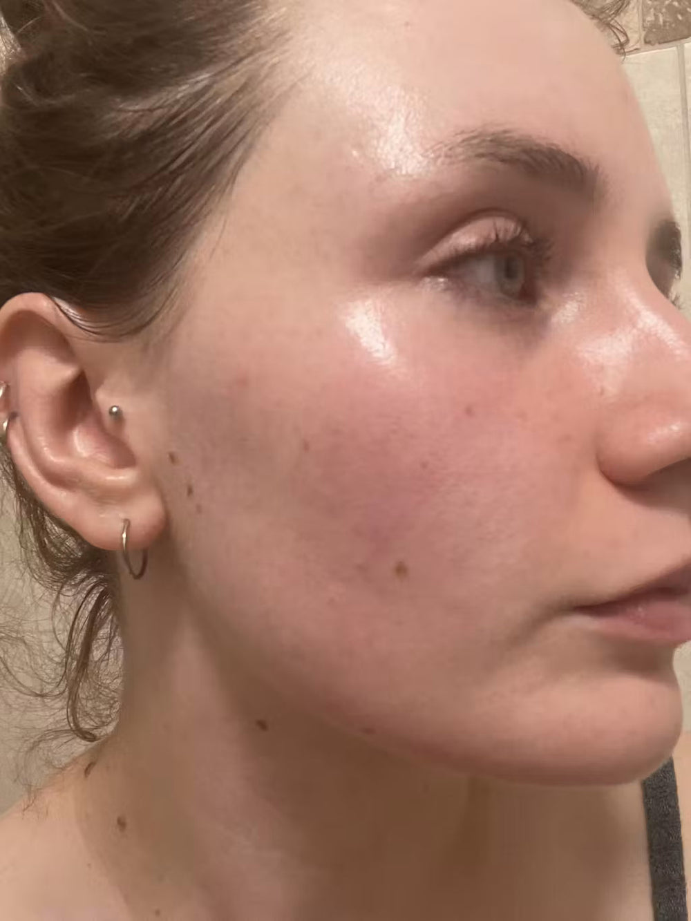 acne CZ keep