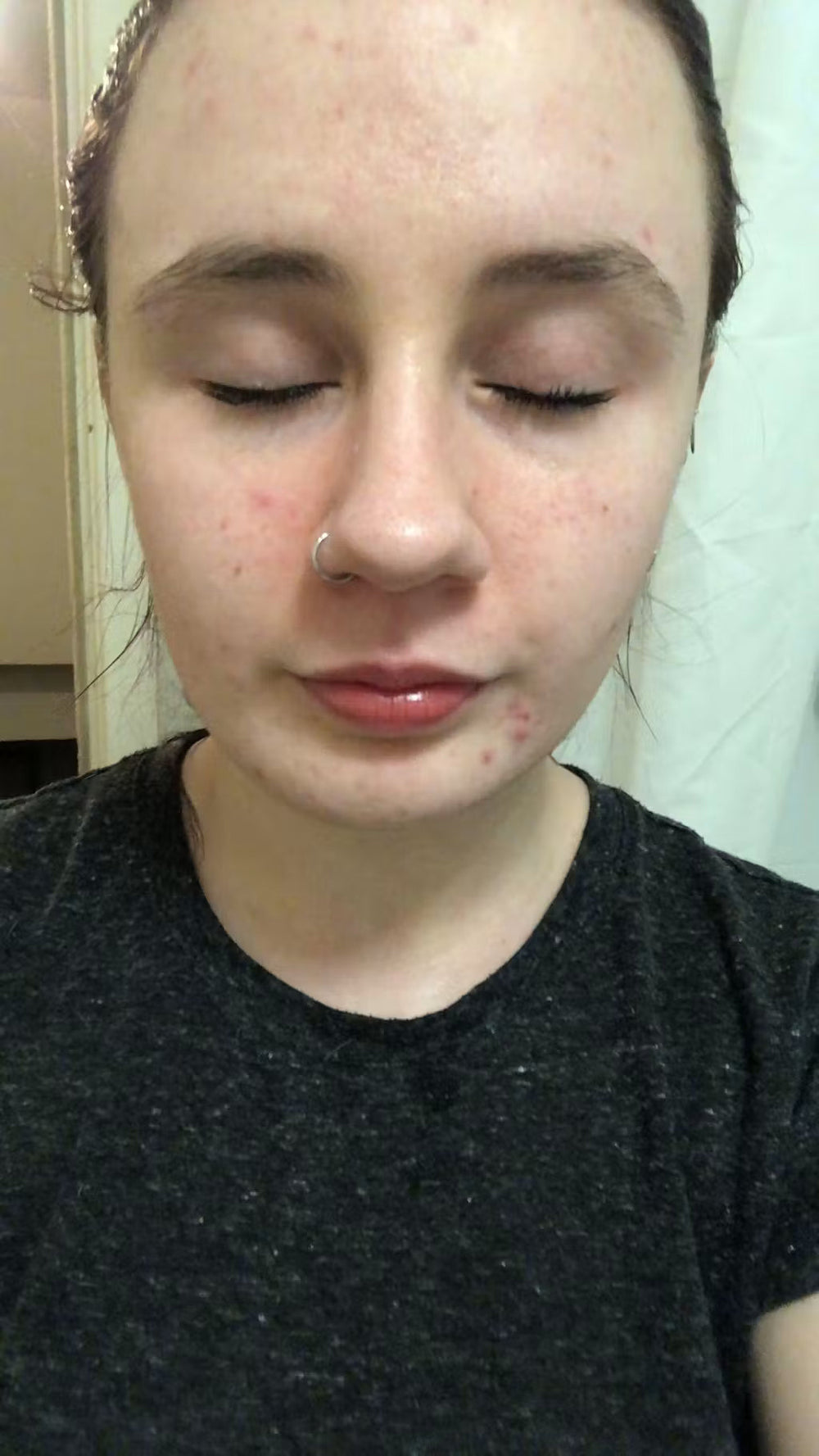 acne CZ keep