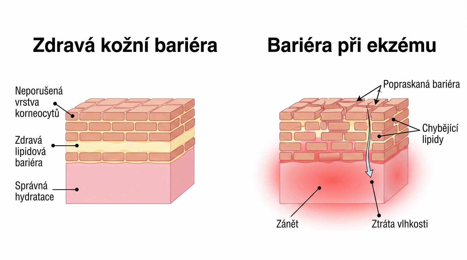 eczema_CZ_skin_barrier_v2.png