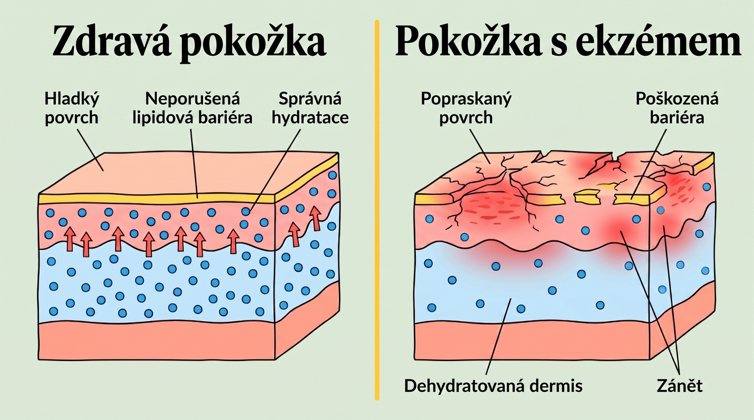 eczema_CZ_skin_layers_v2.png