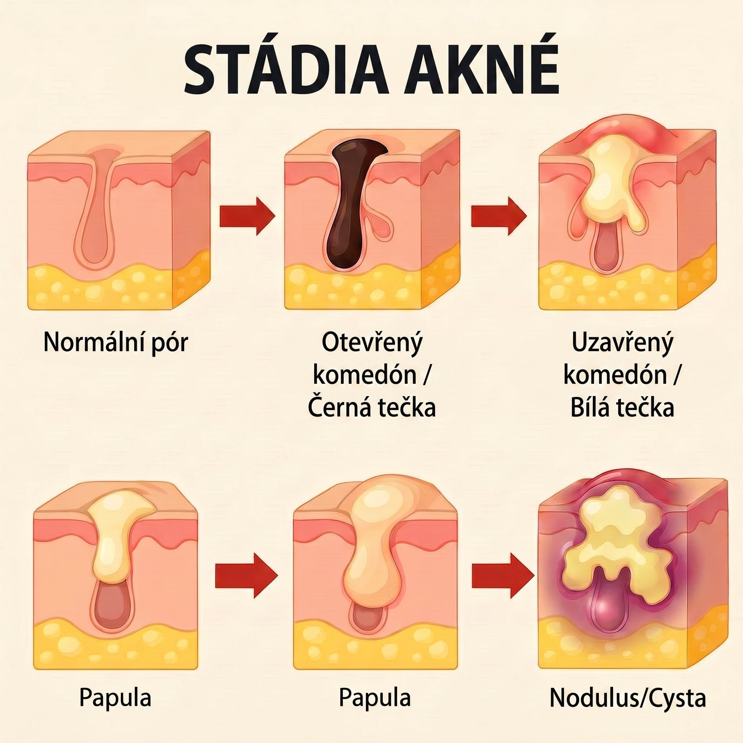 acne CZ translated