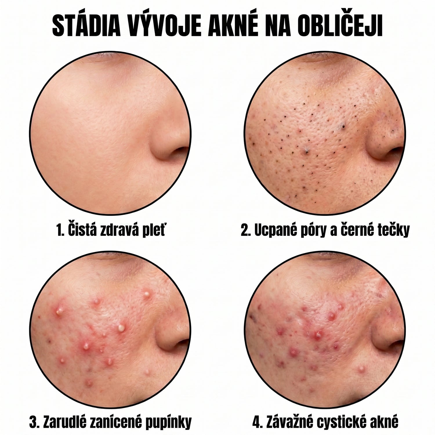 acne CZ translated